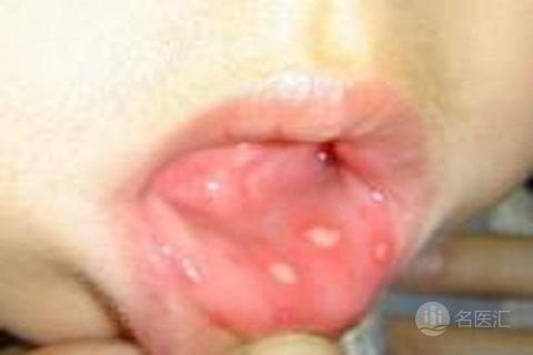 口腔溃疡的治疗方法及穴位,口腔溃疡倪海厦治疗方法