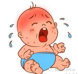 喂母乳会导致宝宝长湿疹吗,宝宝湿疹别再指望忌口