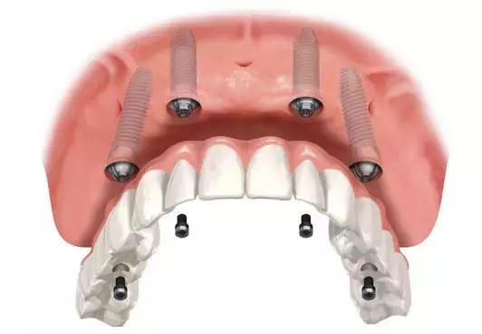 北京种植牙保多少年,韩国产的种植牙能用多少年