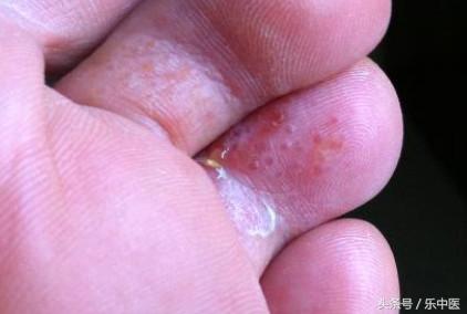 得了脚气很臭怎么办,得了脚气的四个阶段