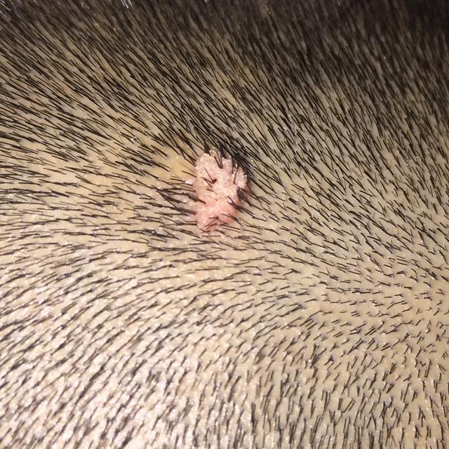 水瘊子去掉母瘊子还会长吗,肉瘊子用手抠了会怎样