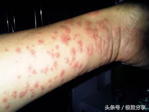 夏季皮肤瘙痒有绝招,皮肤燥热发痒有什么药方治