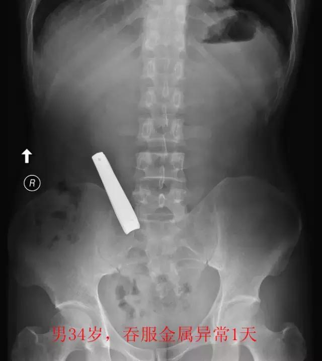 X光片里的体内异物，简直大开眼界