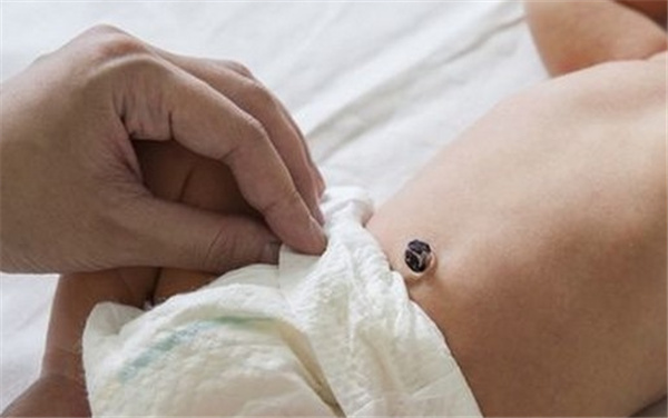 新生儿无尿护理措施,新生儿肚脐护理必备