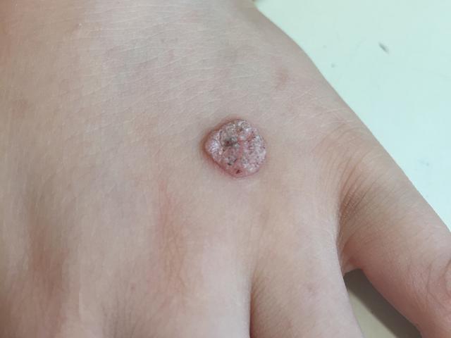 水瘊子去掉母瘊子还会长吗,肉瘊子用手抠了会怎样