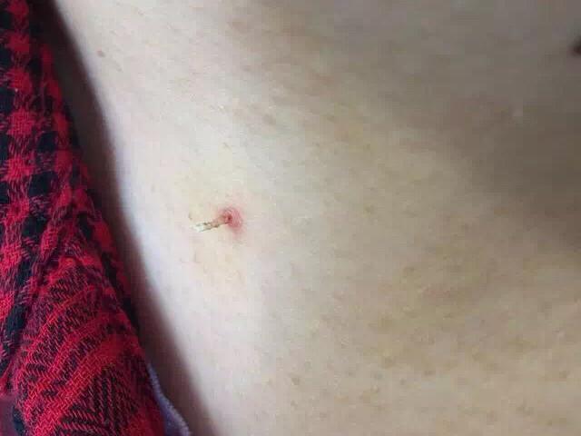 水瘊子去掉母瘊子还会长吗,肉瘊子用手抠了会怎样