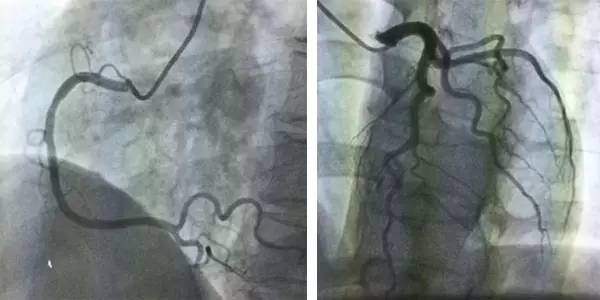 车祸后左胸下方隐隐作痛怎么回事,车祸后胸痛是怎么回事