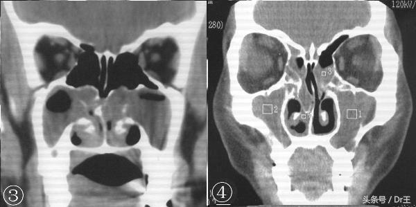 头痛流鼻涕咳嗽有痰全身无力,头痛咳嗽打喷嚏流鼻涕四肢无力