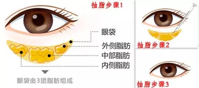 眼袋就要垂到鼻尖了，求支招！