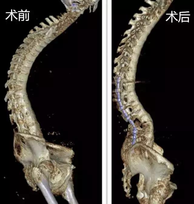 40岁壮汉背弯得像只虾,看看医生是怎么将他“拉直”的