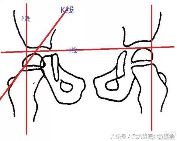 正常骨盆x线片详解,骨科医生只看报告单