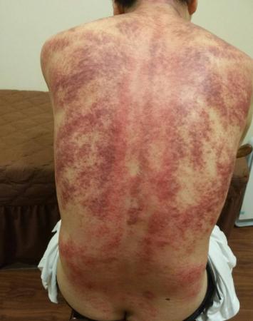 养生的刮痧穴位配图说明,中医养生10种刮痧方法刮走疾病