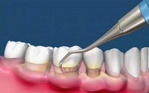 白酒治疗牙周炎的偏方怎么使用,牙周炎反复脓肿也不疼有什么偏方