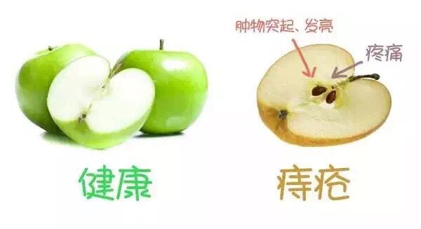 女性生了孩子得痔疮,生产后痔疮会自愈吗