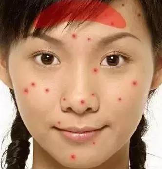 各个地方长痘的原因以及解决方法,长痘到底是什么病啊