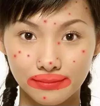 各个地方长痘的原因以及解决方法,长痘到底是什么病啊