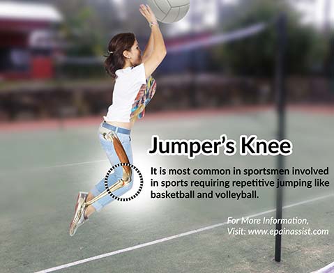 长期运动造成膝盖疼痛怎么恢复,修复膝盖关节最好的运动