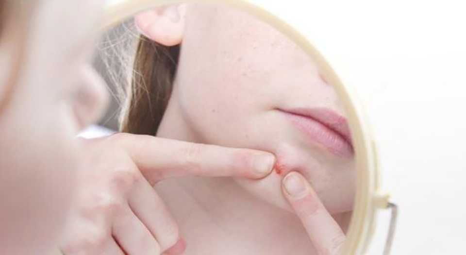 脖子闭口粉刺怎么去除小妙招,粉刺怎么去除简单方法学生