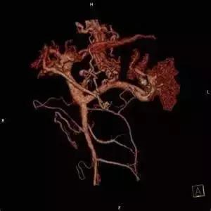 协和肝外科赵海涛专家,赵海涛治胆道肿瘤