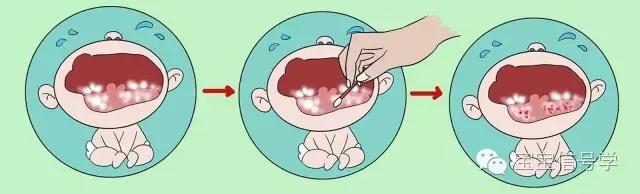宝宝嘴里白白的能擦掉是什么,宝宝嘴巴里是什么颜色