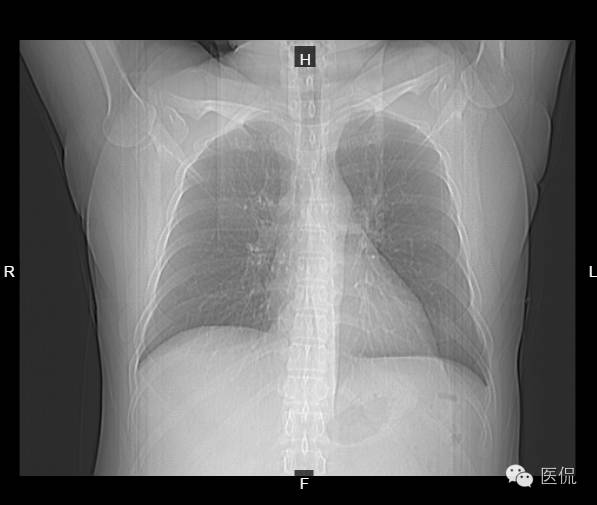 颈椎病例报告,专家诊断脂肪肝
