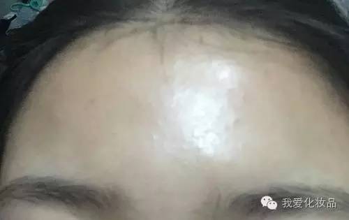 闭口适合用神仙水吗,神仙水祛闭口真的有效吗