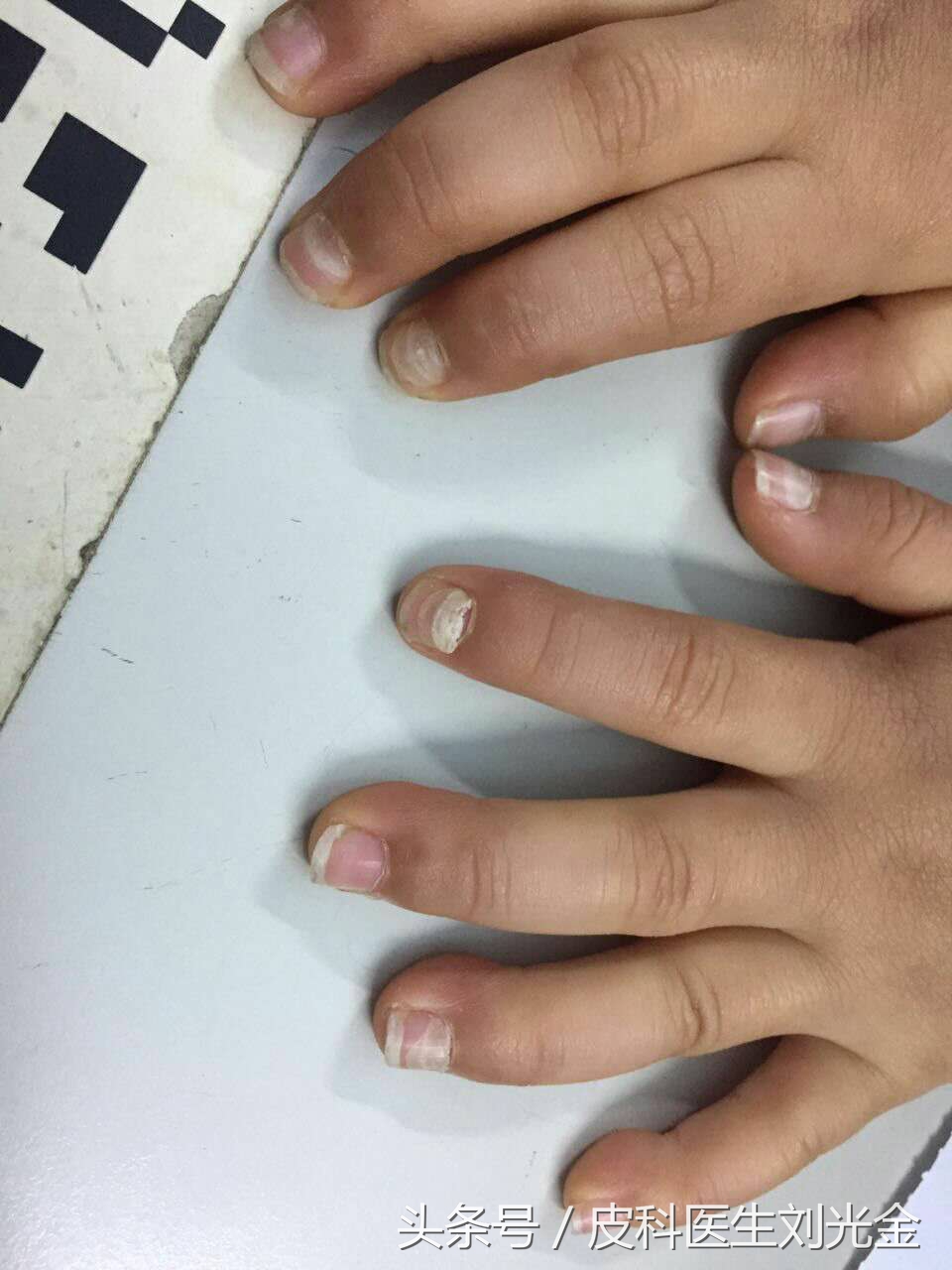 宝宝指甲脱落怎么回事,30个月宝宝指甲脱落是怎么回事