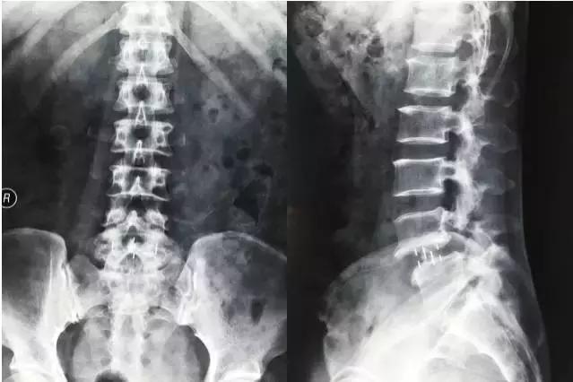 骨伤科可以治疗腰椎滑脱吗,腰椎滑脱微创术后需要康复训练吗