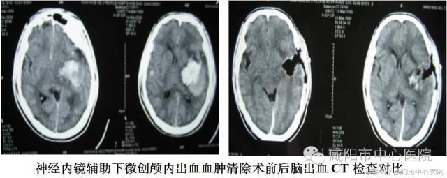 硬膜外血肿保守治疗脑出血,脑出血颅内血肿穿刺引流术后护理