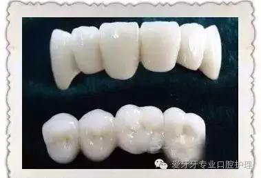不同材质的牙冠的价格,不同价位的烤瓷牙冠