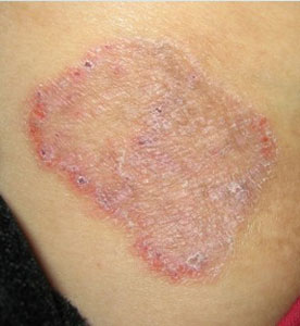 神经性皮炎特别痒怎么缓解,神经性皮炎很痒怎么办