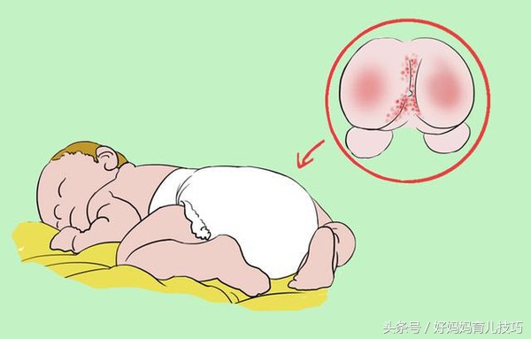 宝宝治疗黄疸期间吐奶,新生儿黄疸10怎么办