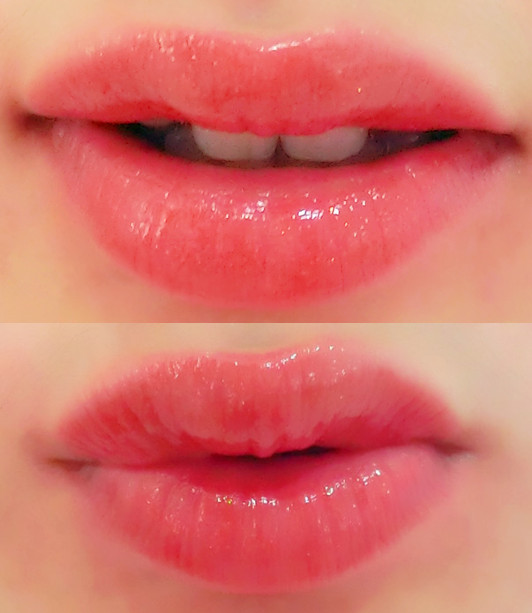 欧洲、亚洲、非洲丰唇标准及注射剂量