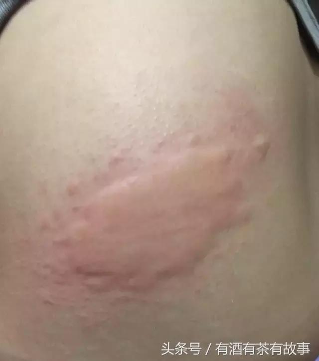 湿疹过敏超级痒,宝宝过敏湿疹妈妈怎么忌口