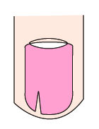 指甲出现白点、纵纹是怎么回事?