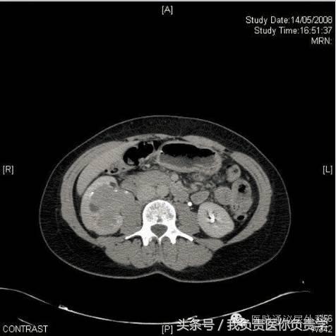 57岁女性出现一次无痛血尿,女性42岁全程无痛性肉眼血尿