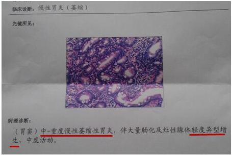 胃镜检查一定要活检才知道胃癌吗,胃镜活检怎么看出胃癌