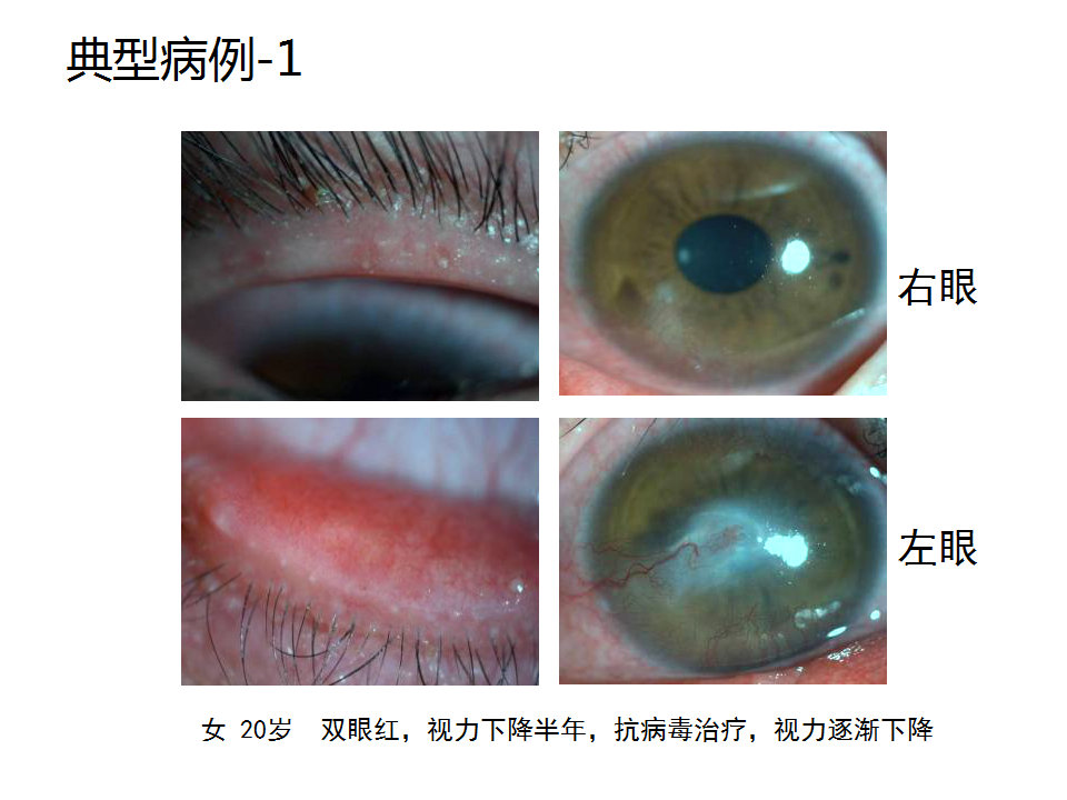 眼睑缘炎的发病原因,眼睑炎的症状和治疗方法
