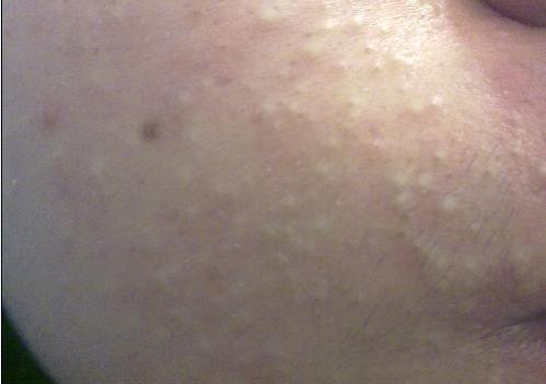 小孩脸上密密麻麻小疙瘩不痛不痒,脸上不痛不痒的小疙瘩是什么