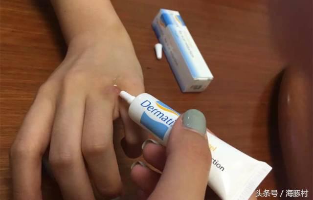 祛疤需要什么条件,目前祛疤最好的方法