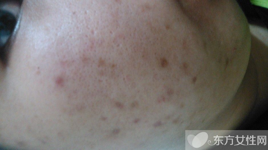 怎么祛痘疤最好的方法,祛痘印痘疤最有效的方法