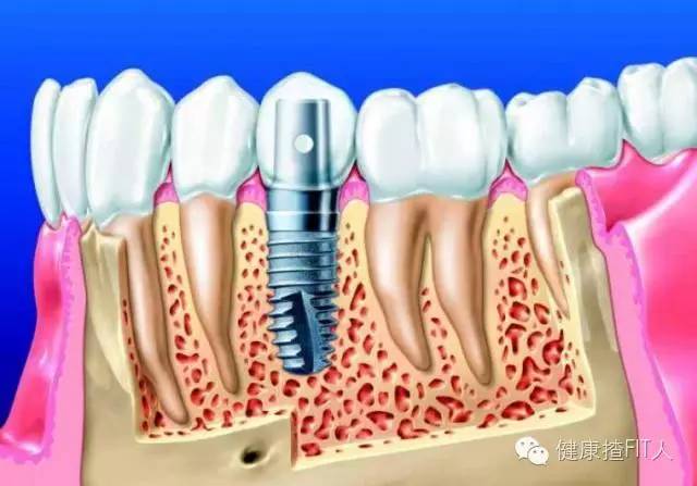 缺牙种植不好还有其他什么方法,老人缺牙去哪里种植放心
