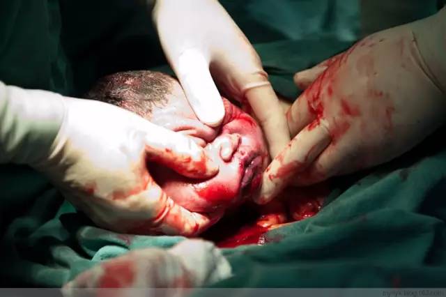 剖腹产恢复很好的照片,剖腹产完全恢复照片