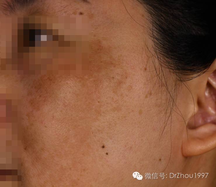 狙杀*褐斑黄**！我们离彻底治愈它还有多远？