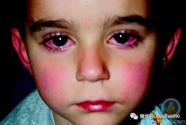 孩子高烧不退当心川崎病,孩子高烧不退当心得了川崎病