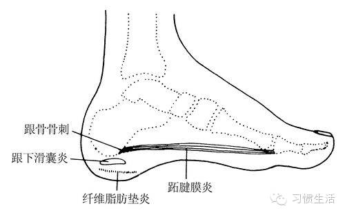 中医讲骨刺原因,中医治疗足骨刺