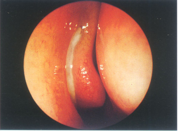 霉菌性上颌窦炎可以吃阿奇霉素,哪些生活习惯会引起霉菌性阴道炎