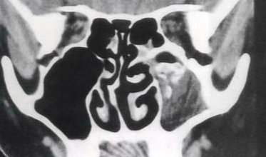 霉菌性上颌窦炎可以吃阿奇霉素,哪些生活习惯会引起霉菌性阴道炎