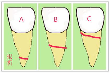 牙齿骨折后能自然愈合吗,骨折可以彻底痊愈吗