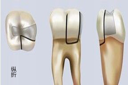 牙齿骨折错位保守治疗能自愈吗,牙齿骨折治疗方法